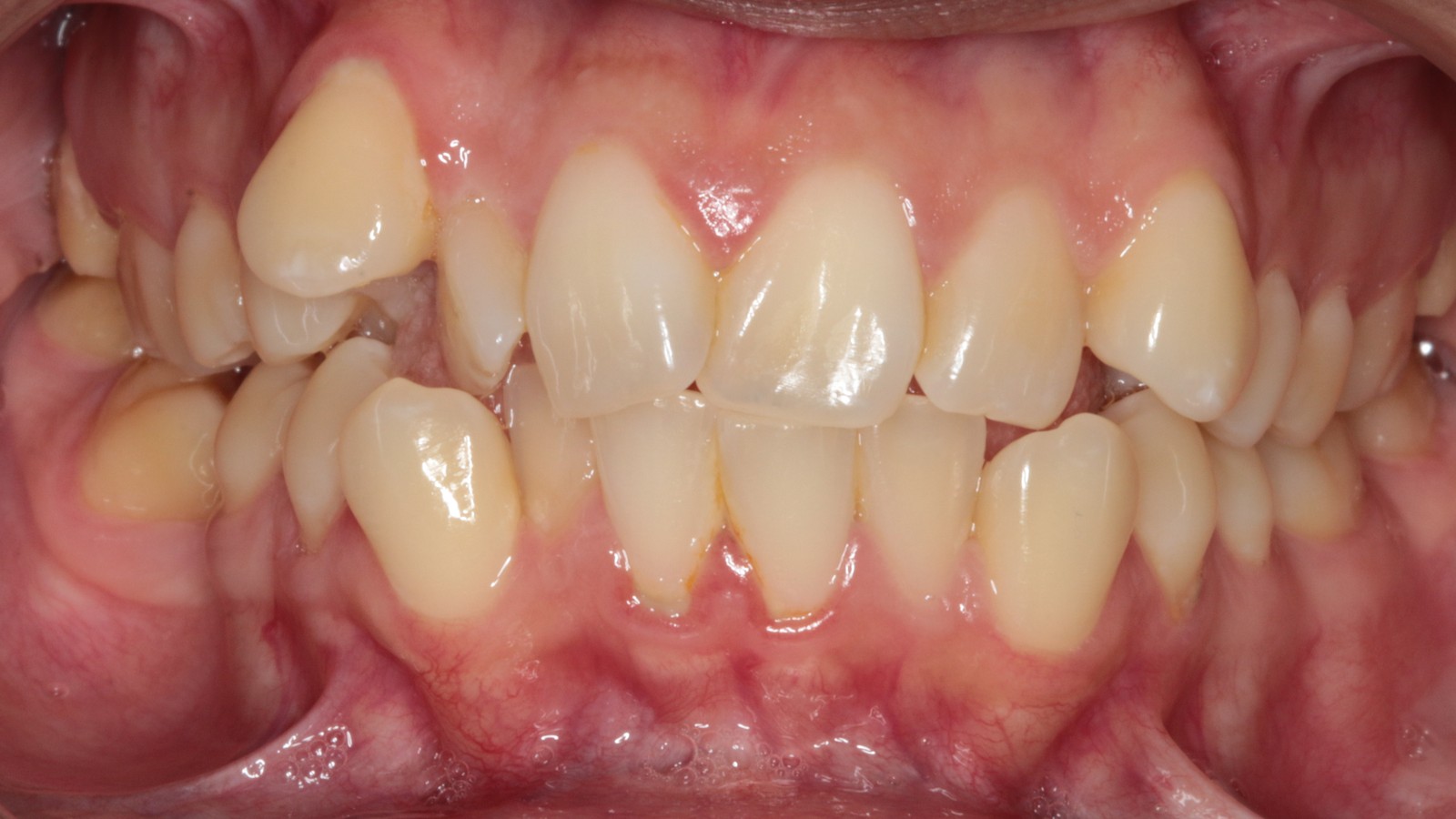 Before treatment: upper and lower crowding
