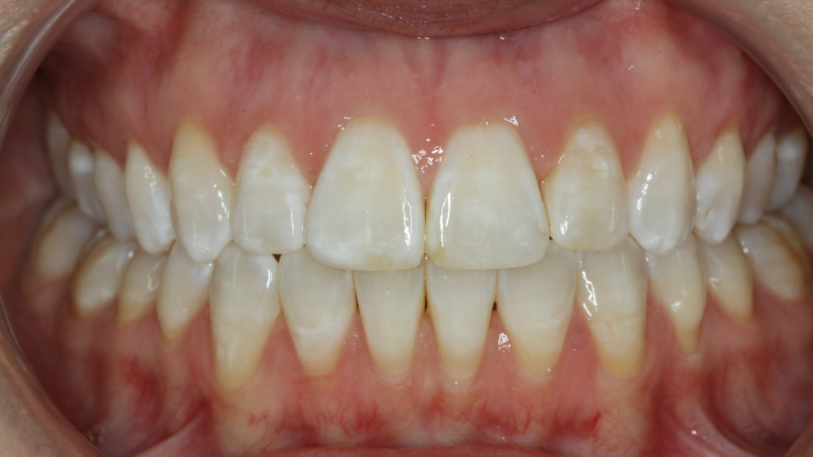 After treatment: front teeth meeting in a closed bite