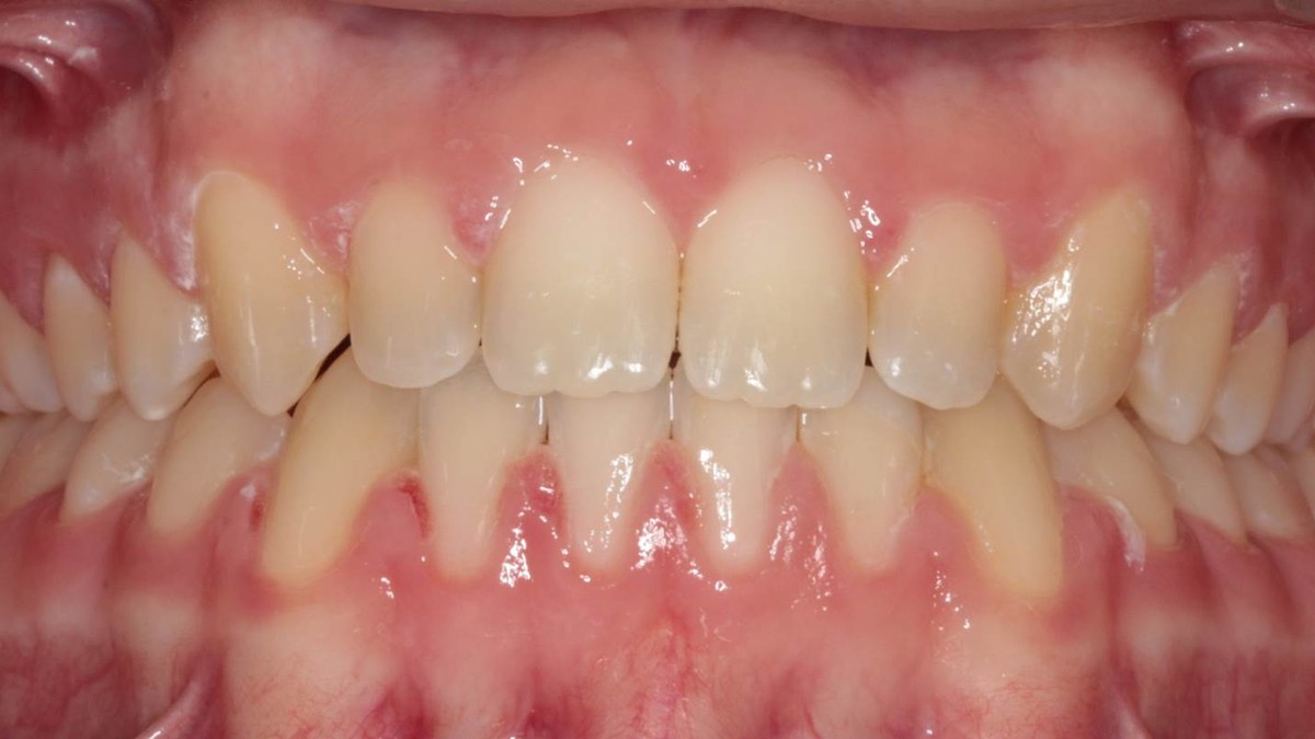 After treatment: spaces closed