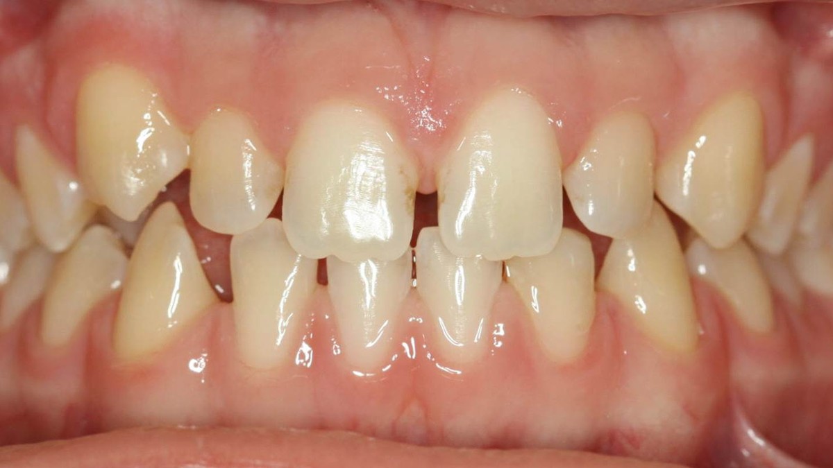 Before treatment: spacing between the teeth