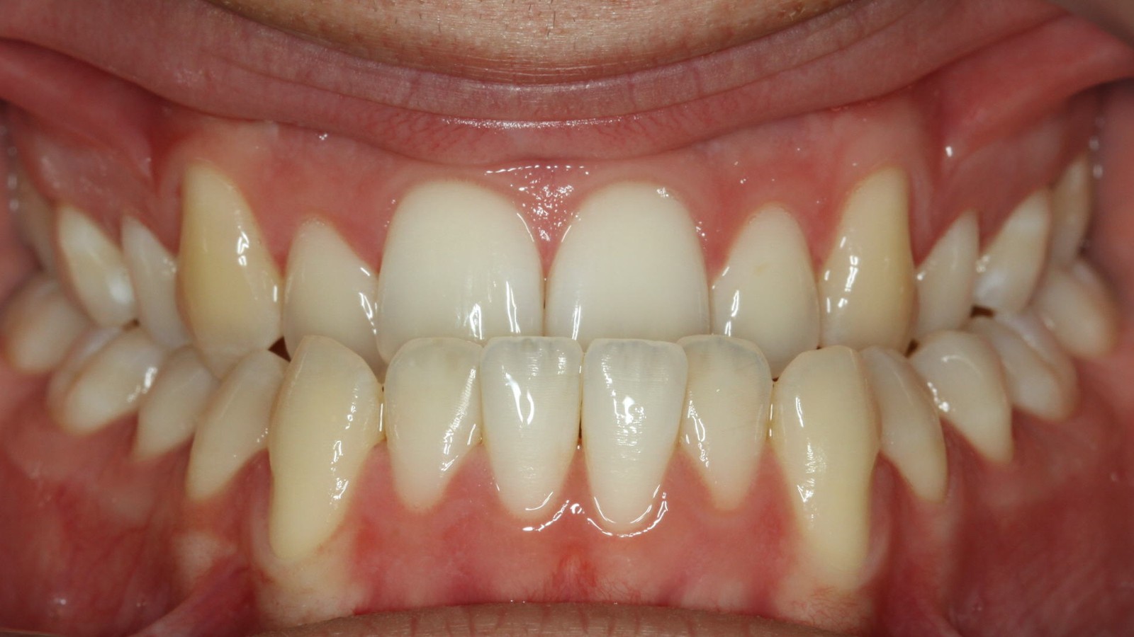 After treatment: corrected underbite