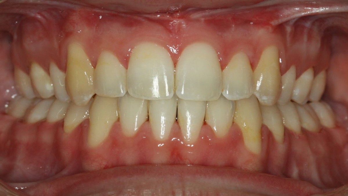 Before treatment: underbite with the lower front teeth ahead of the upper